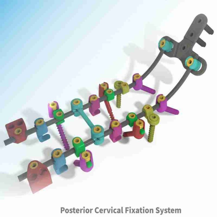 पश्चगामी ग्रीवा निर्धारण प्रत्यारोपण