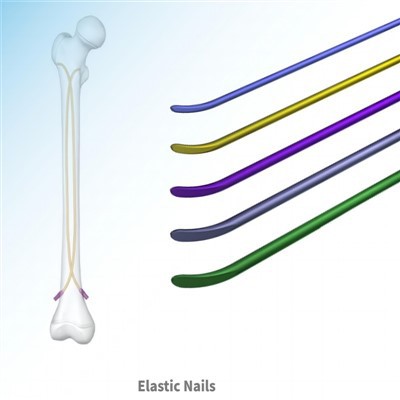 लोचदार इंट्रामेडुलरी नेल