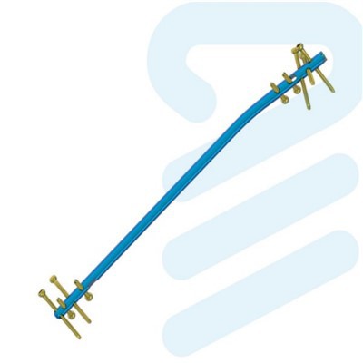 इंट्रामेडुलरी इंटरलॉकिंग नेल टिबिया